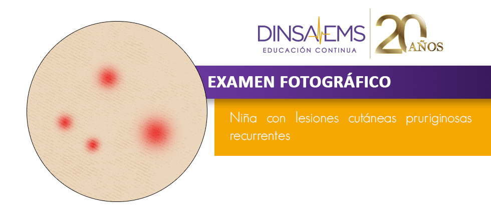 Niña con lesiones cutáneas pruriginosas recurrentes