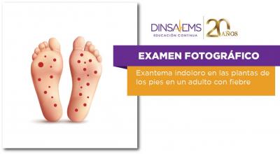 Exantema indoloro en las plantas de los pies en un adulto con fiebre