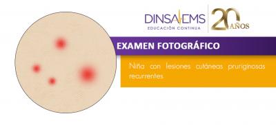 Niña con lesiones cutáneas pruriginosas recurrentes